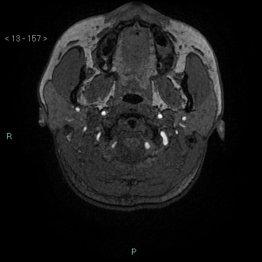 Cholesterol granuloma of the petrous apex (Radiopaedia 64358-73140 Axial TOF 3D 76).jpg