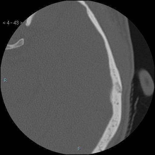 File:Cholesterol granuloma of the petrous apex (Radiopaedia 64358-73141 Axial bone window 21).jpg