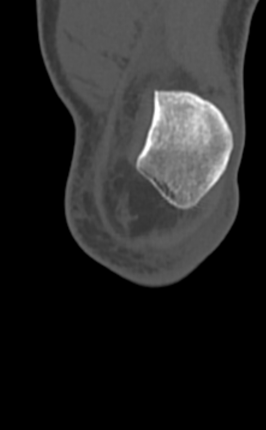 Chondrocalcinosis (Radiopaedia 82862-97173 Coronal bone window 12).jpg