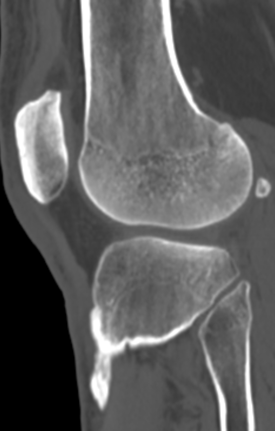 Chondrocalcinosis (Radiopaedia 82862-97173 Sagittal bone window 48).jpg
