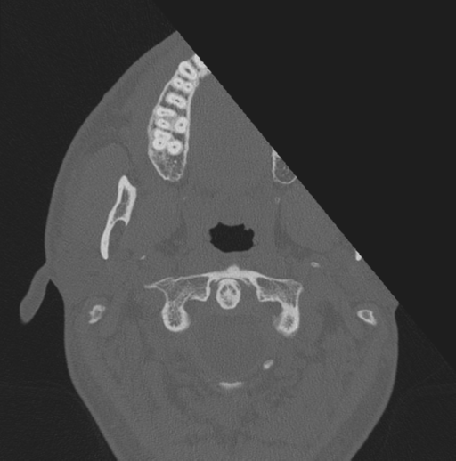 File:Chondrosarcoma (clivus) (Radiopaedia 46895-51425 Axial bone window 84).png