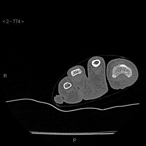 Chondrosarcoma - phalanx (Radiopaedia 69047-78812 Axial bone window 28).jpg