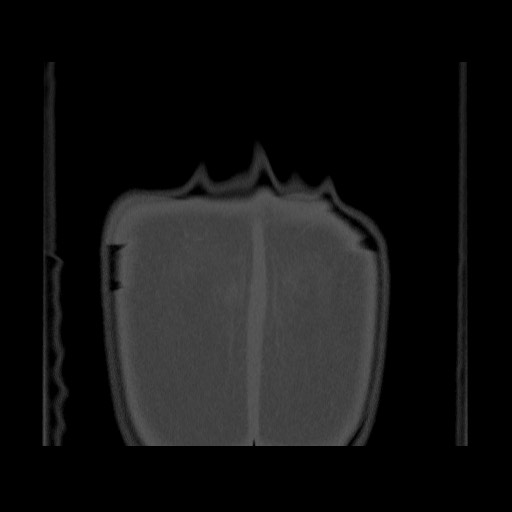 Chondrosarcoma of iliac wing (Radiopaedia 63861-72599 Coronal bone window 114).jpg