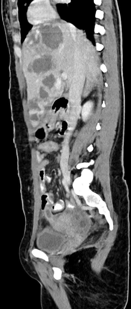 Choriocarcinoma liver metastases (Radiopaedia 74768-85766 C 111).jpg