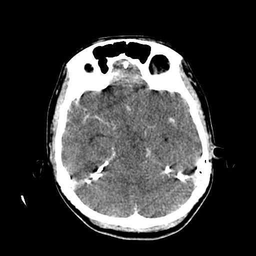 File:Choriocarcinoma of ovary with cerebral and pulmonary metastases (Radiopaedia 25983-26118 C+ arterial phase 57).jpg