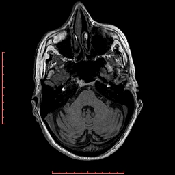 Choroid plexus xanthogranuloma (Radiopaedia 67843-77270 Axial T1 124).jpg