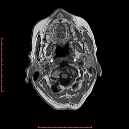 Choroid plexus xanthogranuloma (Radiopaedia 67843-77270 Axial T1 153).jpg