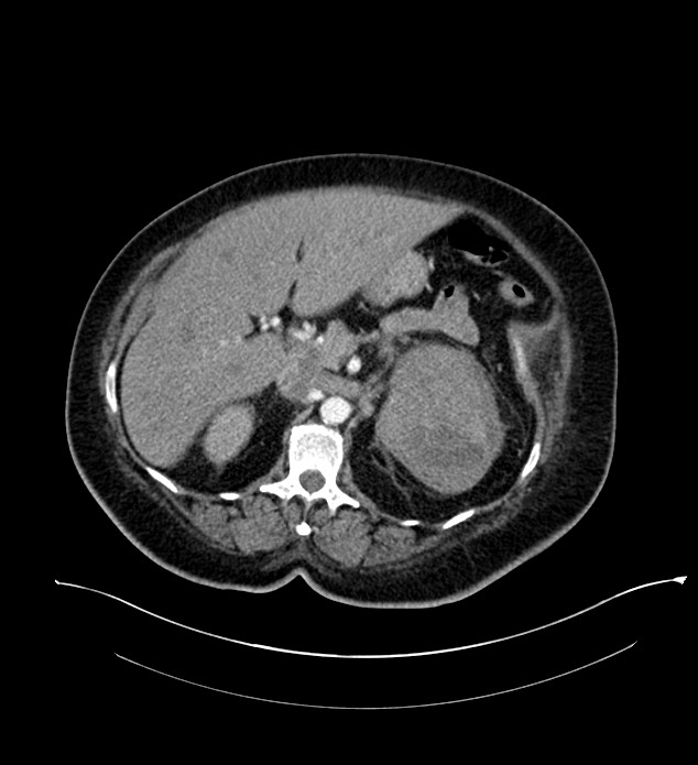 Chromophobe renal cell carcinoma (Radiopaedia 84239-99519 B 39).jpg