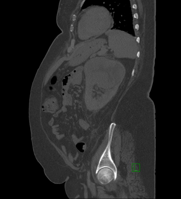 Chromophobe renal cell carcinoma (Radiopaedia 84239-99519 Sagittal bone window 28).jpg