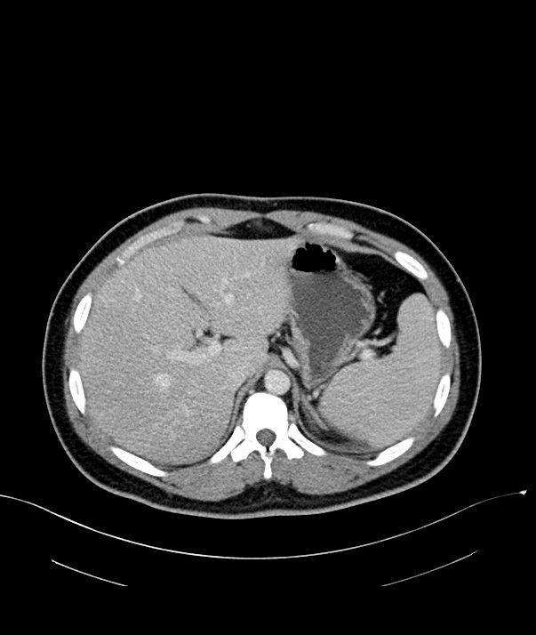 Chromophobe renal cell carcinoma (Radiopaedia 84255-99542 F 18).jpg