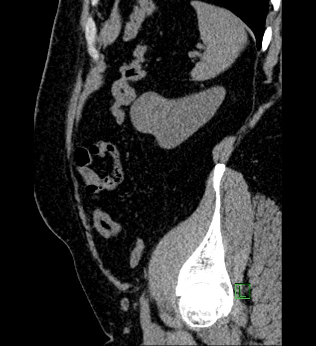 Chromophobe renal cell carcinoma (Radiopaedia 84286-99573 C 34).jpg