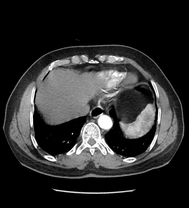 Chromophobe renal cell carcinoma (Radiopaedia 86879-103083 B 16).jpg