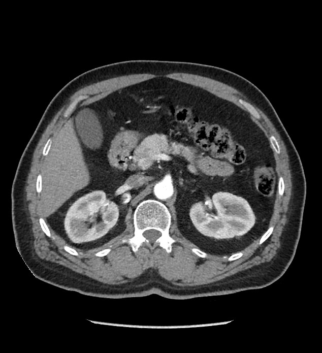 Chromophobe renal cell carcinoma (Radiopaedia 86879-103083 B 49).jpg