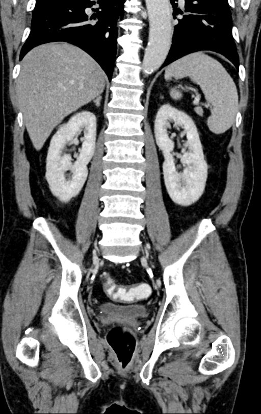 Chronic appendicitis complicated by appendicular abscess, pylephlebitis and liver abscess (Radiopaedia 54483-60700 C 54).jpg
