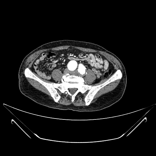 File:Chronic contained rupture of abdominal aortic aneurysm with extensive erosion of the vertebral bodies (Radiopaedia 55450-61901 A 49).jpg