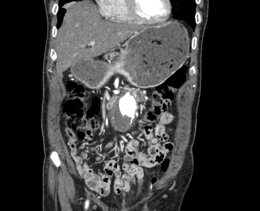 Chronic contained rupture of abdominal aortic aneurysm with extensive erosion of the vertebral bodies (Radiopaedia 55450-61901 D 11).jpg