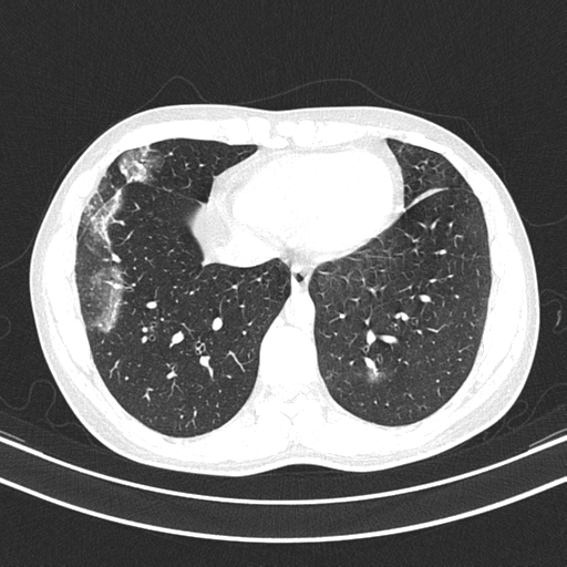 File:Chronic eosinophilic pneumonia (Radiopaedia 39331-41587 Axial lung window 40).png