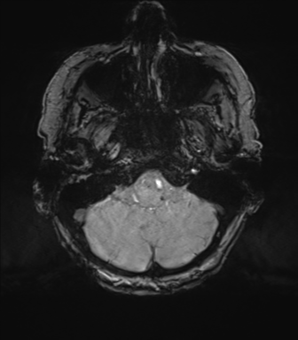 Chronic hypertensive encephalopathy (Radiopaedia 72844-83495 Axial SWI magnitude 13).png