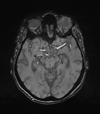Chronic hypertensive encephalopathy (Radiopaedia 72844-83495 Axial SWI magnitude 34).png