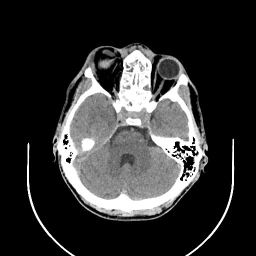 Chronic invasive fungal sinusitis (Radiopaedia 50342-55710 Axial non-contrast 52).jpg