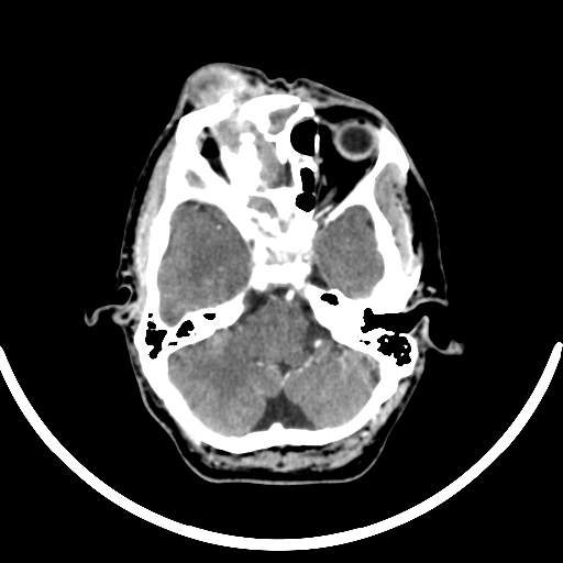 Chronic invasive fungal sinusitis with intraorbital and intracranial extension (Radiopaedia 56387-63046 B 109).jpg