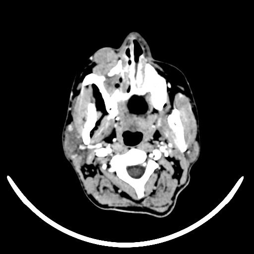 Chronic invasive fungal sinusitis with intraorbital and intracranial extension (Radiopaedia 56387-63046 B 12).jpg