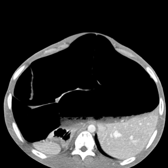 Chronic large bowel pseudo-obstruction (Radiopaedia 43181-46492 A 51).jpg