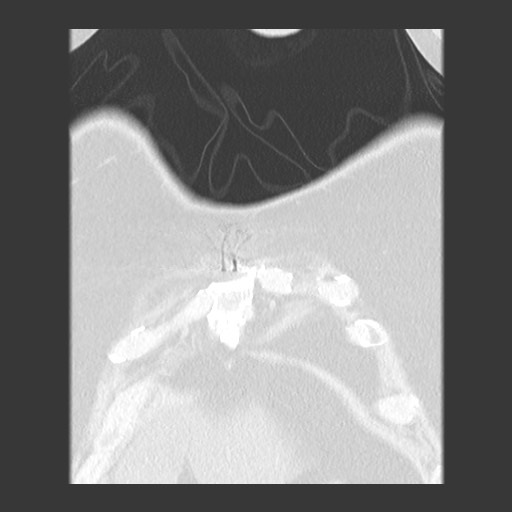 Chronic lung allograft dysfunction - restrictive form (Radiopaedia 60595-68316 Coronal lung window 17).jpg