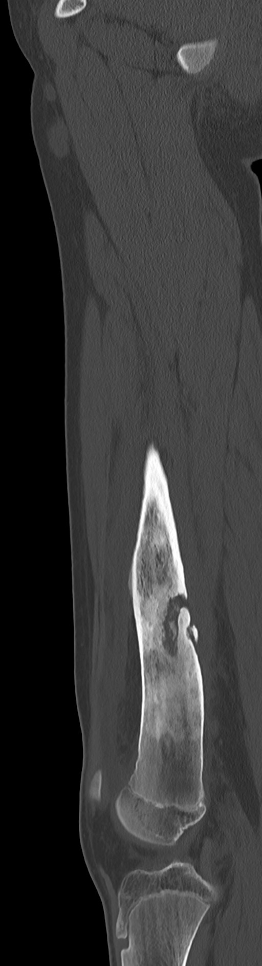 Chronic ostemyelitis of the femur with long sinus tract (Radiopaedia 74947-85982 Sagittal bone window 54).jpg