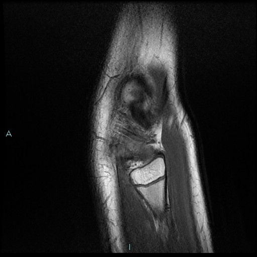 File:Chronic osteomyelitis (with Brodie abscess) (Radiopaedia 76405-88112 Sagittal PD 24).jpg