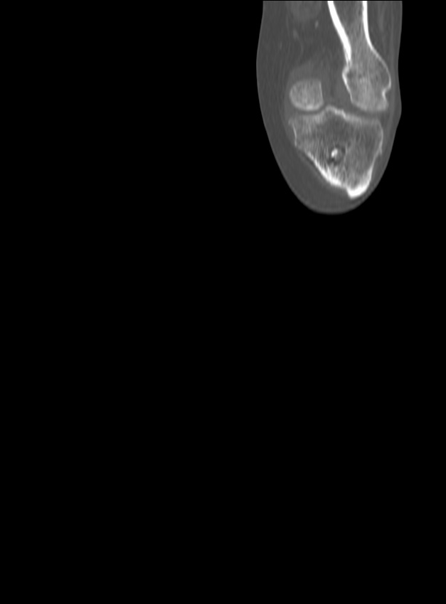 Chronic osteomyelitis - tibia (with sequestrum) (Radiopaedia 73273-84090 Coronal non-contrast 9).jpg