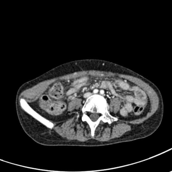 Chronic pancreatitis (Radiopaedia 55405-61846 A 65).jpg