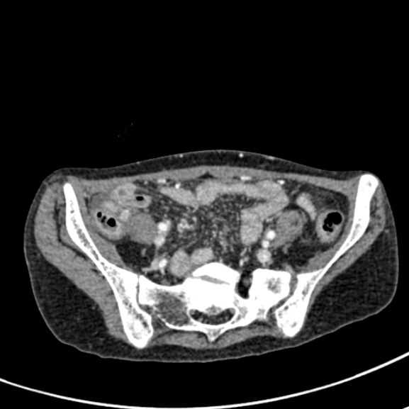Chronic pancreatitis (Radiopaedia 55405-61846 A 79).jpg