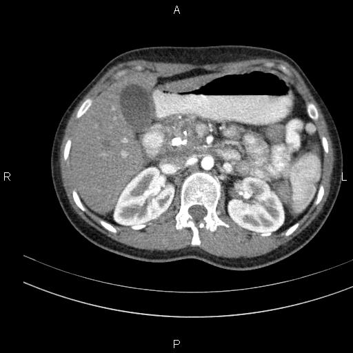Chronic pancreatitis (Radiopaedia 64576-73450 B 50).jpg