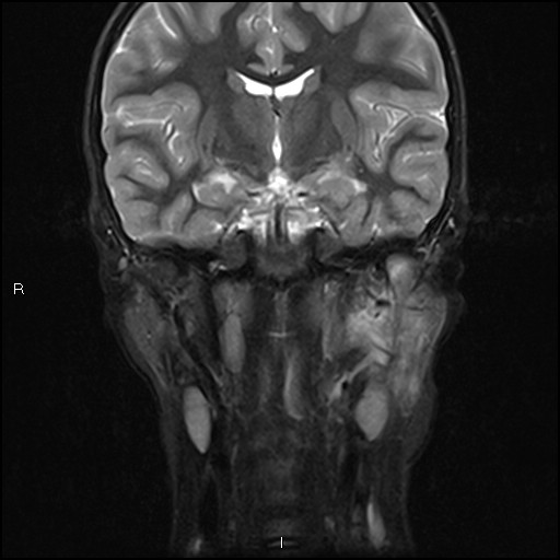 File:Chronic reactive multifocal osteomyelitis (CRMO) - mandible (Radiopaedia 56405-63069 Coronal STIR 21).jpg