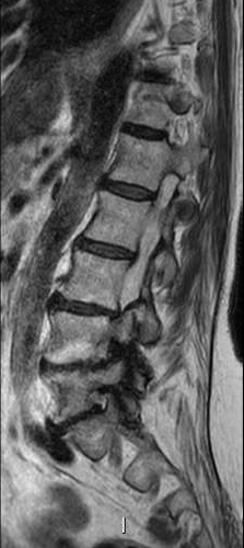 File:Chronic spinal hematoma with cauda equina syndrome (Radiopaedia 75745-87090 Sagittal T2 4).png