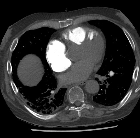 Chronic thromboembolic pulmonary disease (Radiopaedia 90694-108119 Axial C+ CTPA 60).jpg