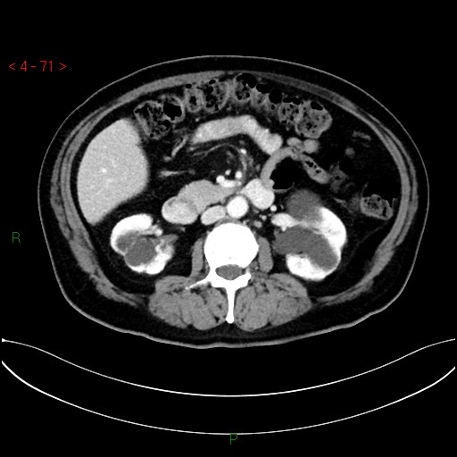 File:Circumaortic left renal vein and doubled left renal arteries (Radiopaedia 52268-58158 B 31).jpg