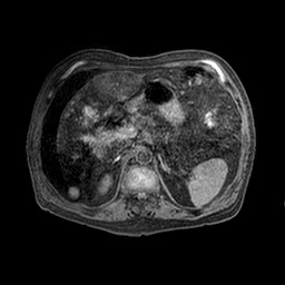 Cirrhosis and hepatocellular carcinoma in the setting of hemochromatosis (Radiopaedia 75394-86594 Axial T1 C+ fat sat 42).jpg