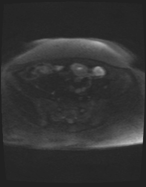 Class II Mullerian duct anomaly- unicornuate uterus with rudimentary horn and non-communicating cavity (Radiopaedia 39441-41755 Axial DWI 70).jpg