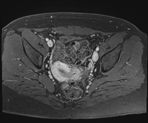 File:Class II Mullerian duct anomaly- unicornuate uterus with rudimentary horn and non-communicating cavity (Radiopaedia 39441-41755 Axial T1 fat sat 65).jpg
