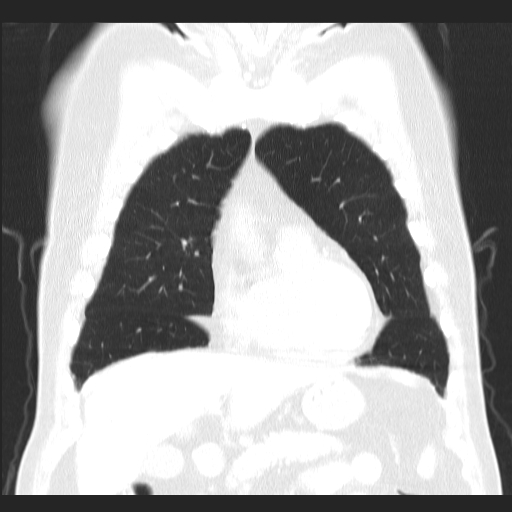 File:Classic complicated silicosis (Radiopaedia 49720-54961 Coronal lung window 16).jpg