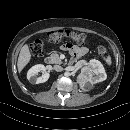 File:Clear cell renal cell carcinoma (Radiopaedia 61449-69393 E 34).jpg