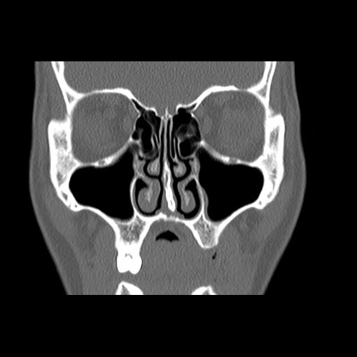 File:Cleft hard palate and alveolus (Radiopaedia 63180-71710 Coronal bone window 18).jpg