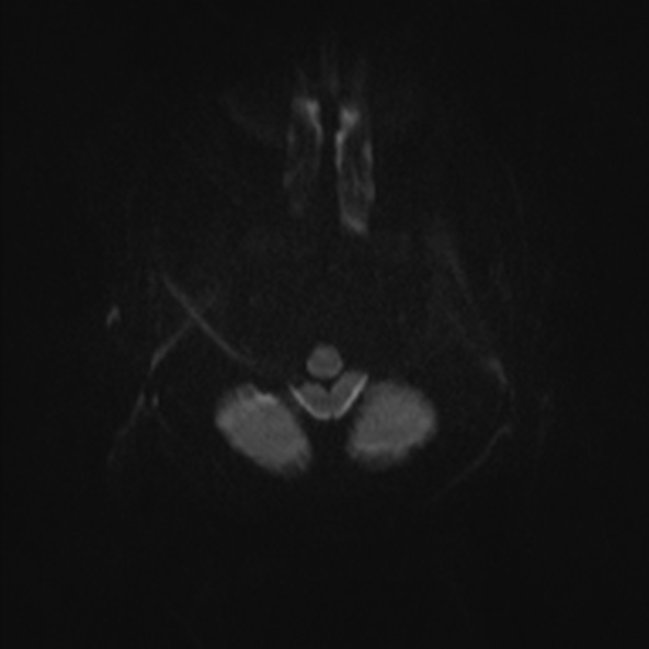 File:Clival meningioma (Radiopaedia 53278-59248 Axial DWI 26).jpg