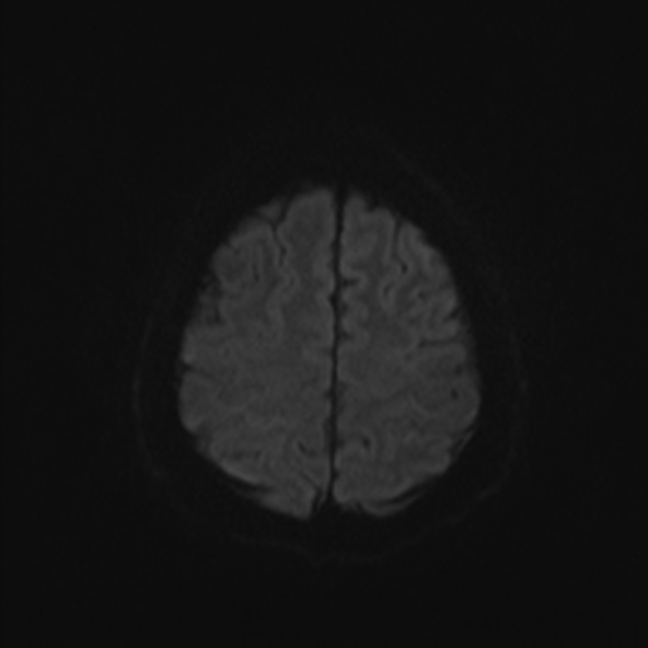 File:Clival meningioma (Radiopaedia 53278-59248 Axial DWI 46).jpg