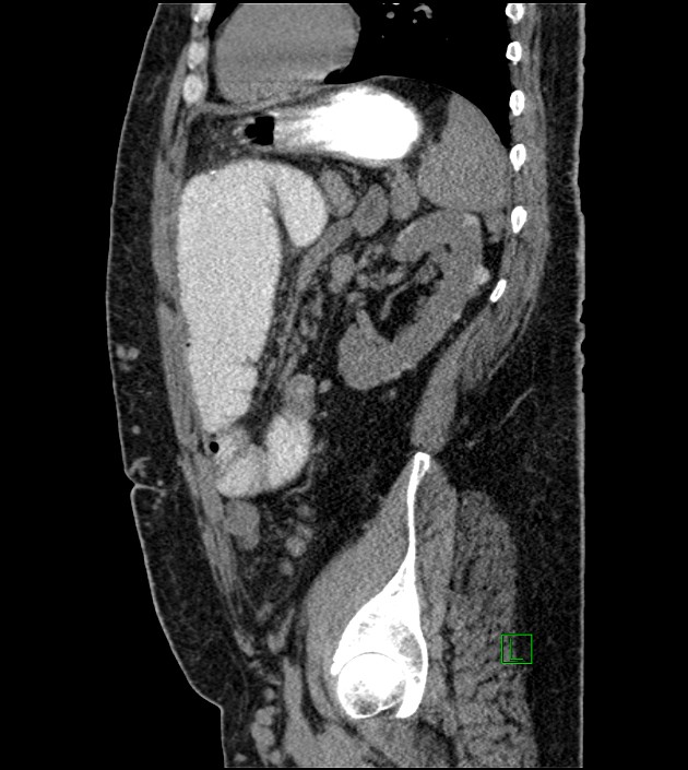 Closed-loop small bowel obstruction-internal hernia (Radiopaedia 78439-91096 C 50).jpg