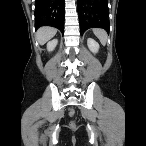 Closed-loop small bowel obstruction (Radiopaedia 73713-84509 C 95).jpg