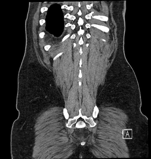 Closed loop obstruction - internal hernia into nephrectomy bed (Radiopaedia 59867-67320 B 128).jpg