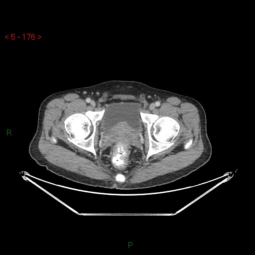 File:Closed loop obstruction and appendicular stump mucocele (Radiopaedia 54014-61158 A 78).jpg